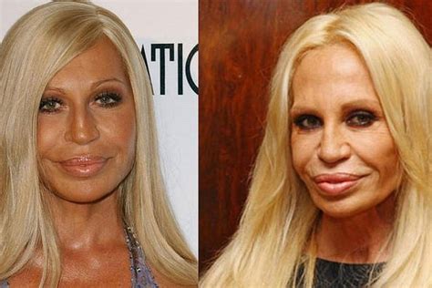 donatella versace antes y despues de cirugias